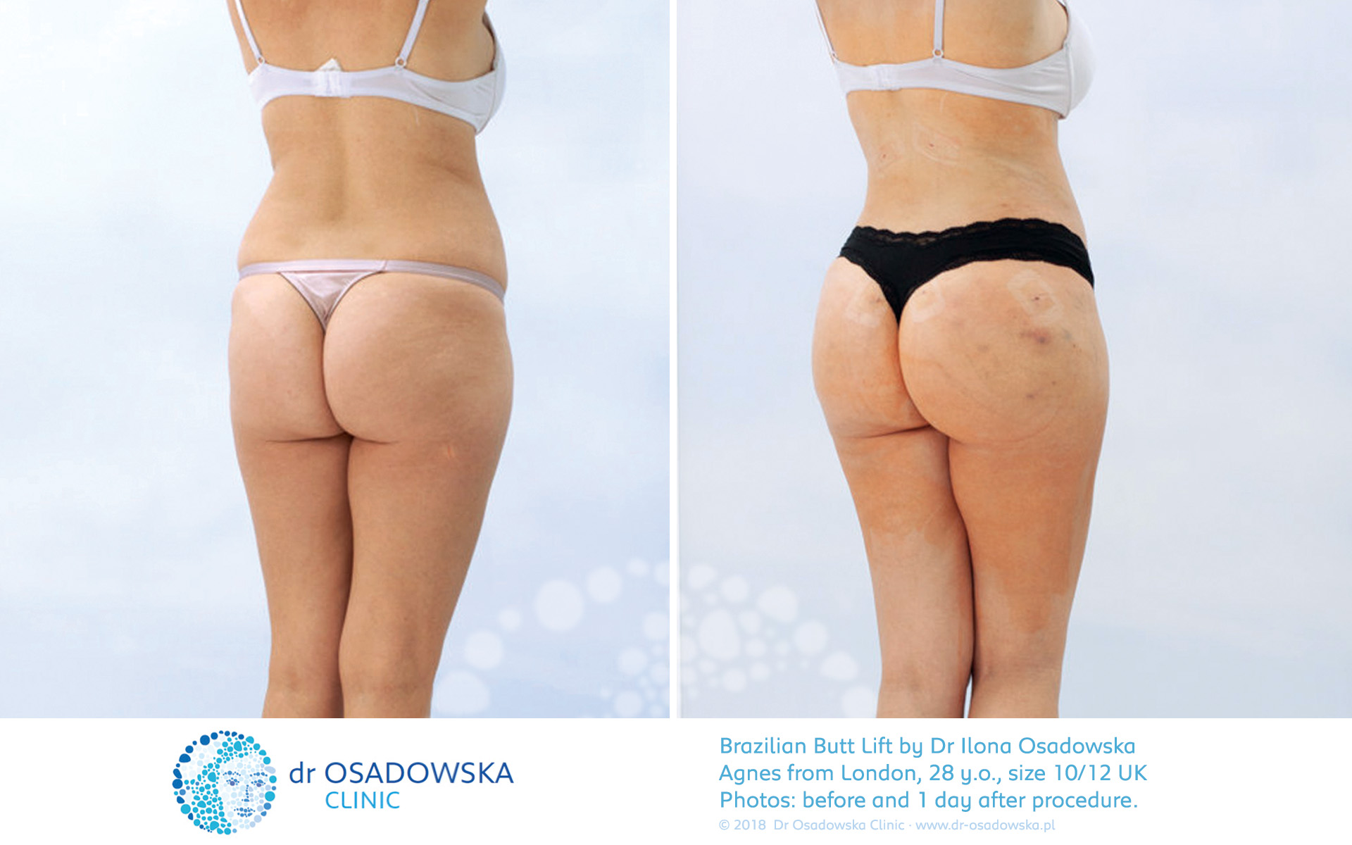 https://www.dr-osadowska.com/doku/bbl-brazilian-butt-lift-agnes-before-after-1-day.jpg